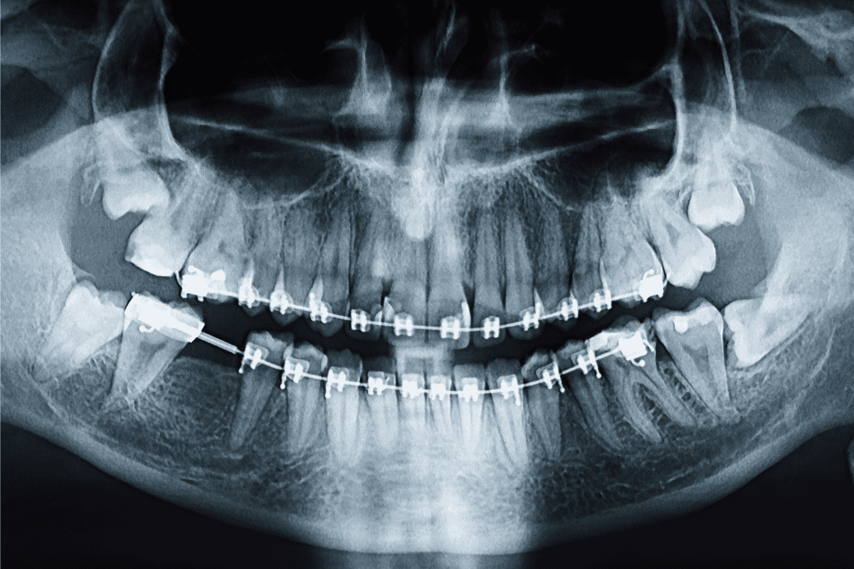 Orthodontic XRays With Braces Are They Safe? Beach Braces