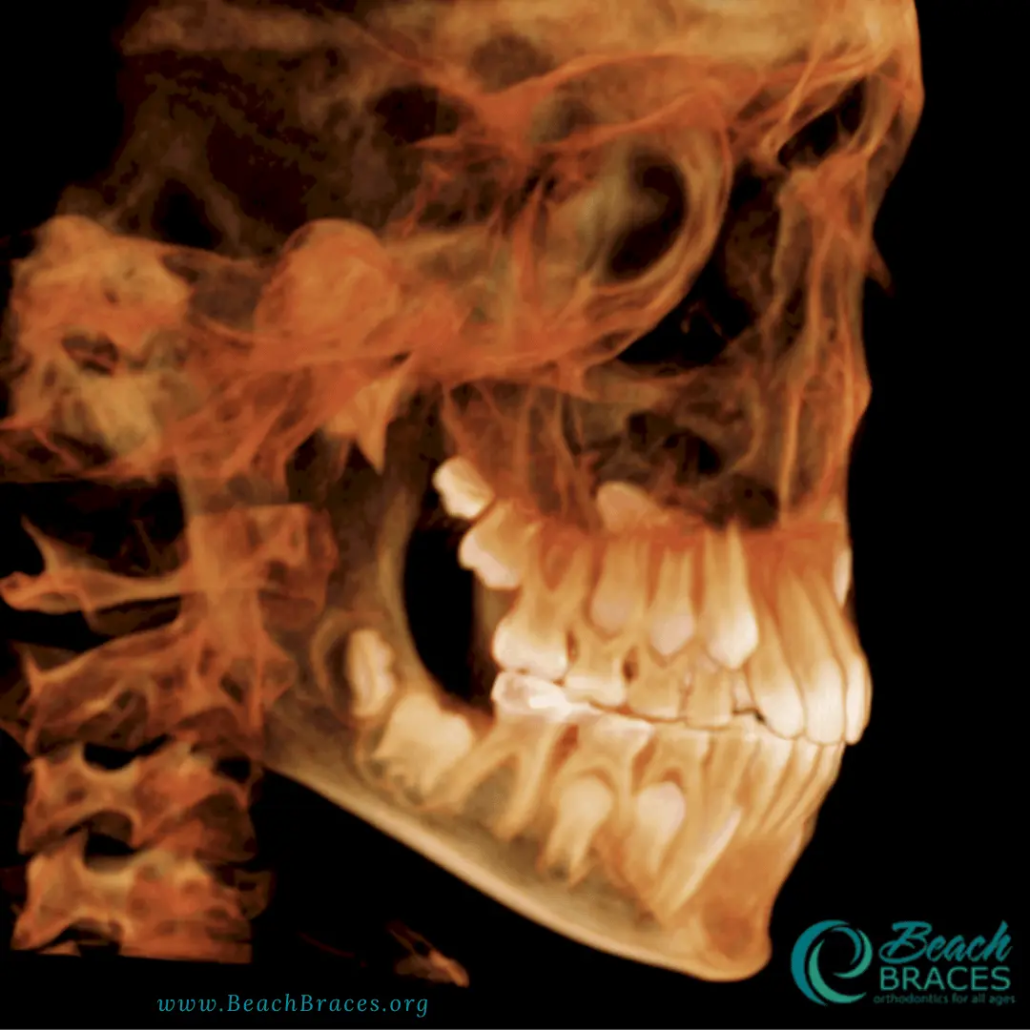 3D Imaging Before Invisalign or Braces - Beach Braces