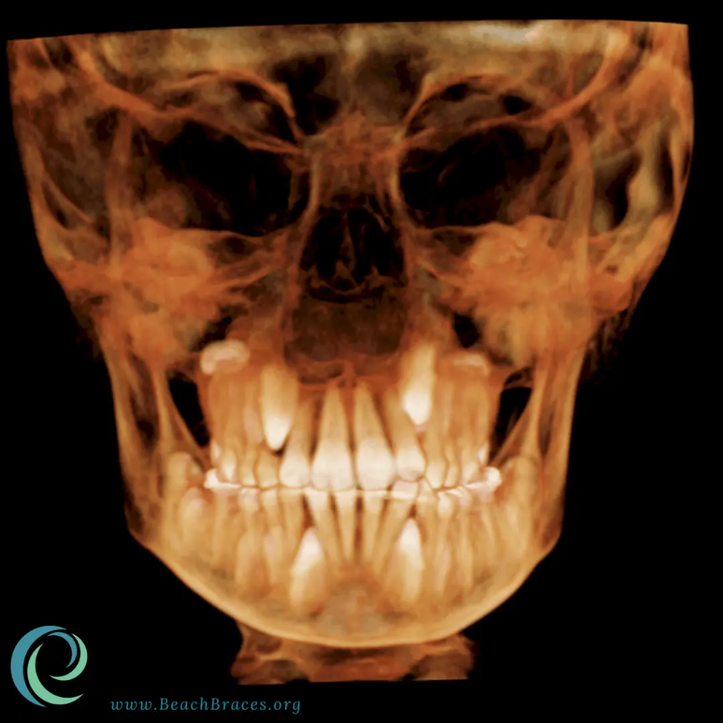 Why 3D Imaging Matters Before Invisalign or Braces - Beach Braces