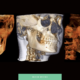 Why 3D Imaging Matters Before Invisalign or Braces in Manhattan Beach - Beach Braces