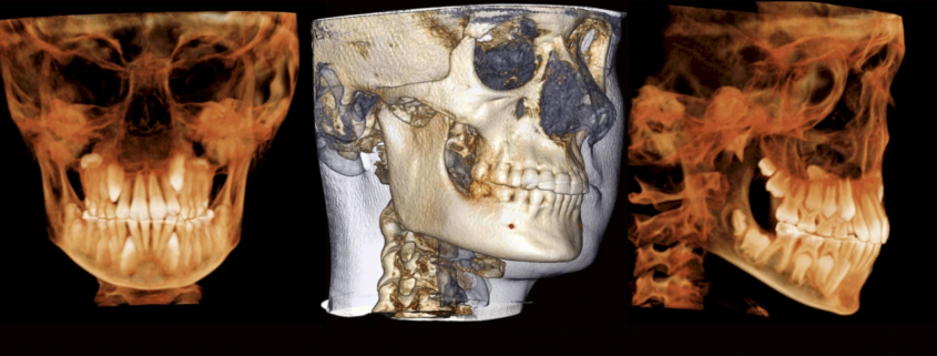 Why 3D Imaging Matters Before Invisalign or Braces in Manhattan Beach - Beach Braces